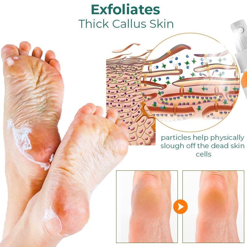 Foot Callus Removal Spray GFOUK