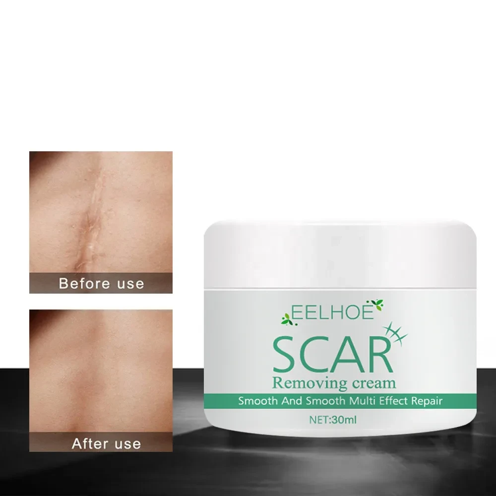 Skin Smoothing And Repairing Cream For Scalding And Burn Scars