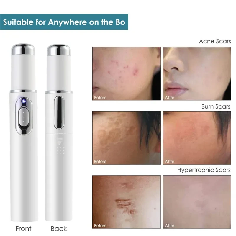 Blue Light Therapy Acne Laser Pen Soft Scar Wrinkle Removal Treatment Device Skin Care Beauty Equipment