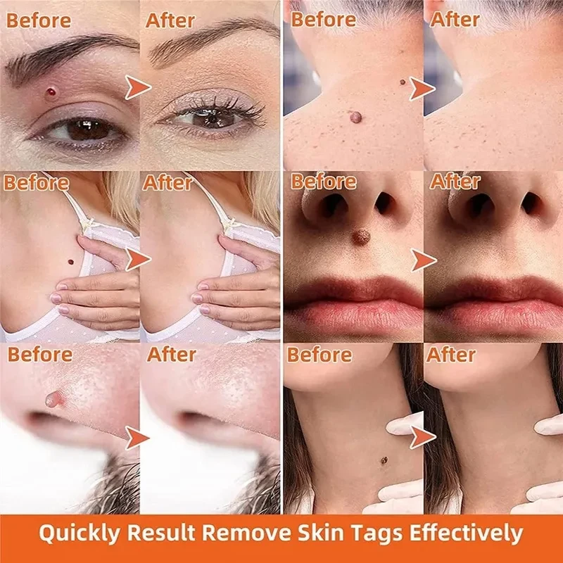 Moisturizing Facial Wart Remover Liquid