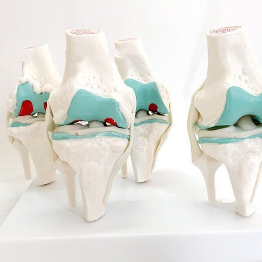 Four-Stage Diseased Knee Joint Model Sick Joint Model