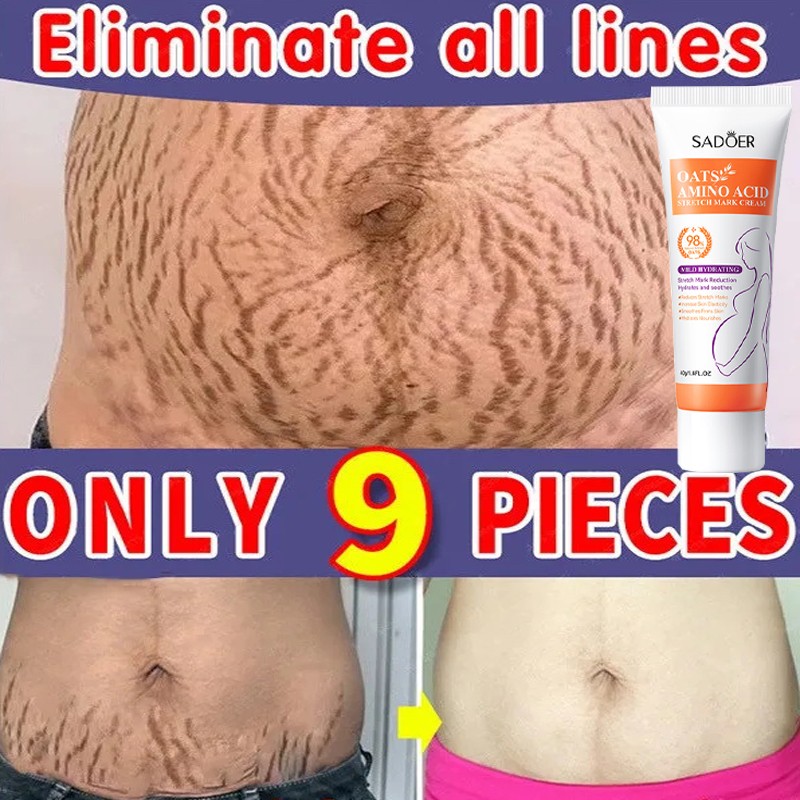 Stretch Marks Permanent Removal Cream - Skin Repair and Firming Care