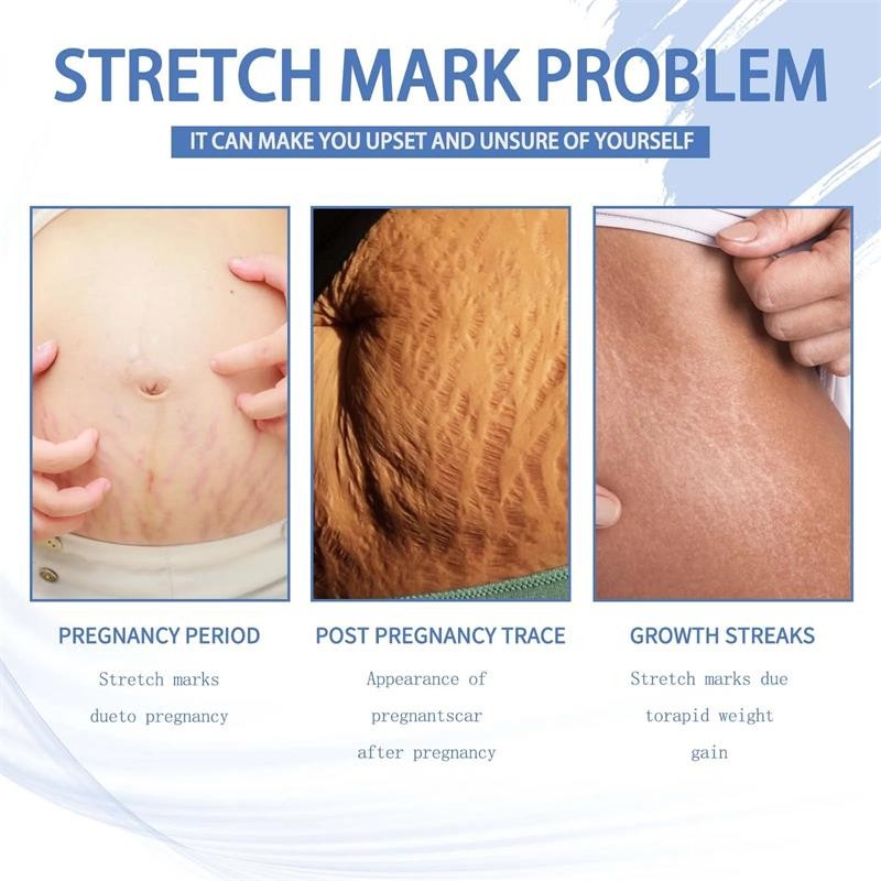 Stretch Marks Permanent Removal Cream - Skin Repair and Firming Care