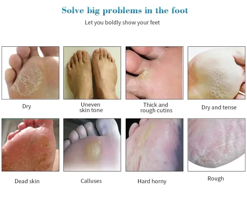 Whitening Heels Feet Peeling Anti Cracked Foot Skin Care