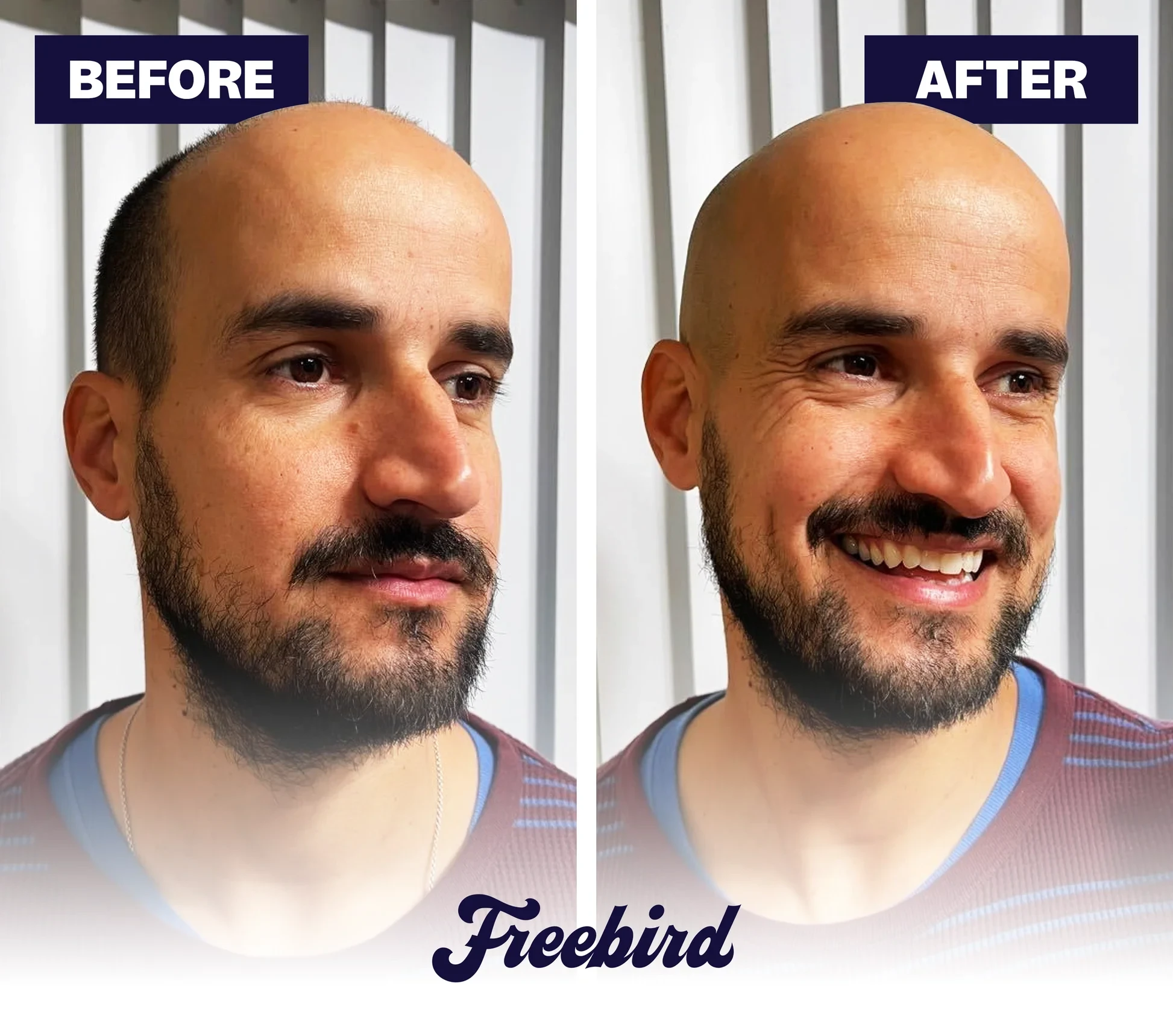 Effortless Head Shaving: Must-Have Shaver For Bald Guys