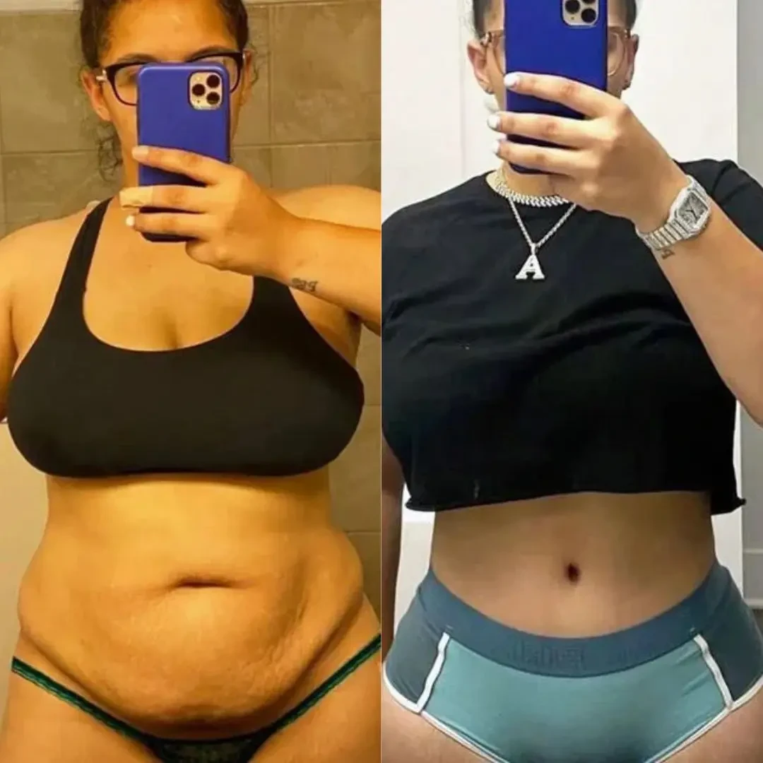 Sonicfit™ Ultrasonic Cavitation