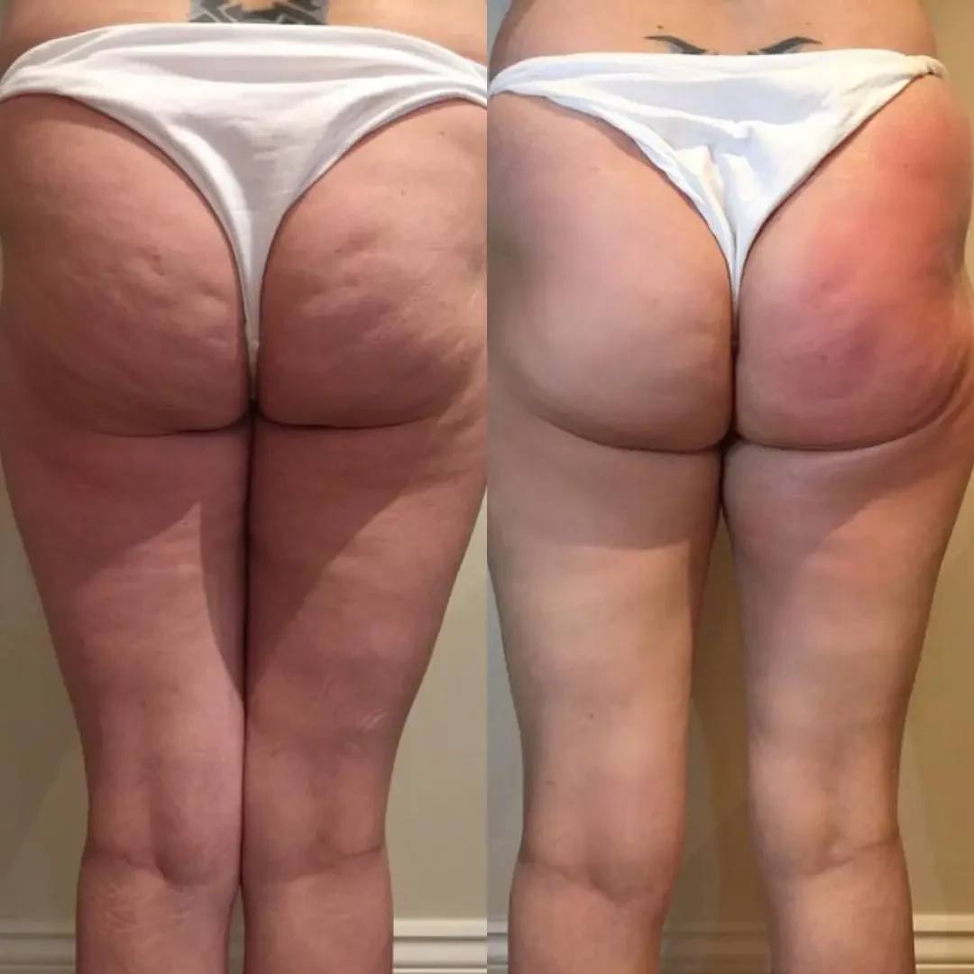 Sonicfit™ Ultrasonic Cavitation