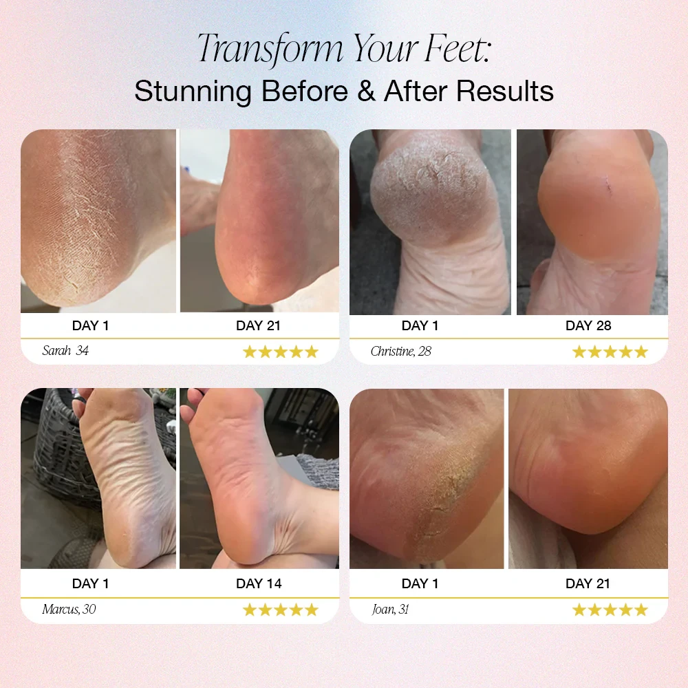 Dermave™ Electric Foot Callus Remover