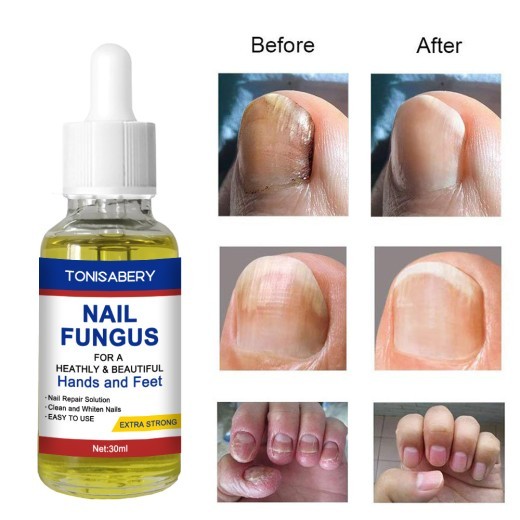 Nail To Remove Nails30 Ml