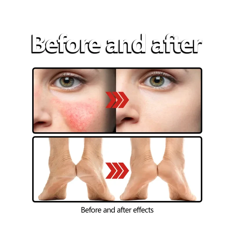 Cream Relieves Sunscreen Anti-itch Skin care lotion