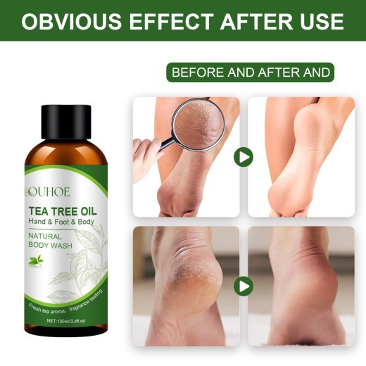 Foot Heel Calluses Crack Exfoliating Skin Care Solution